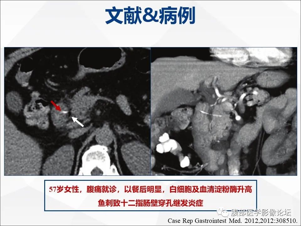 影像PPT - 【病例】异物穿孔伴胰腺炎1例CT及MR影像-31