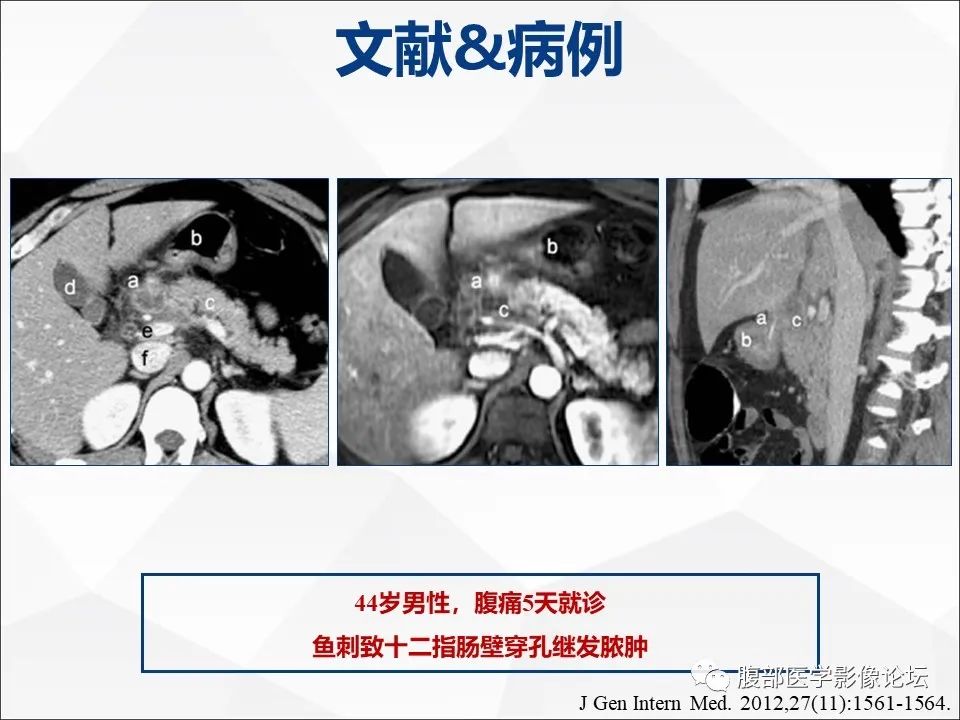 影像PPT - 【病例】异物穿孔伴胰腺炎1例CT及MR影像-32