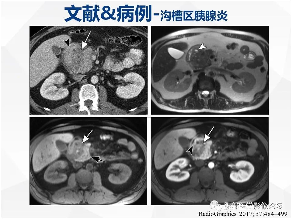 影像PPT - 【病例】异物穿孔伴胰腺炎1例CT及MR影像-34