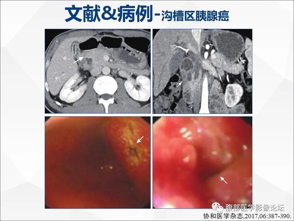 影像PPT - 【病例】异物穿孔伴胰腺炎1例CT及MR影像-36