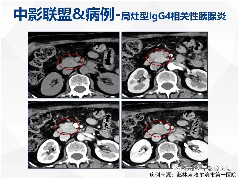影像PPT - 【病例】异物穿孔伴胰腺炎1例CT及MR影像-38
