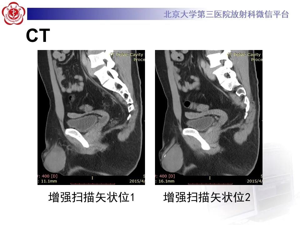 影像PPT - 【PPT】精原细胞瘤的影像-8