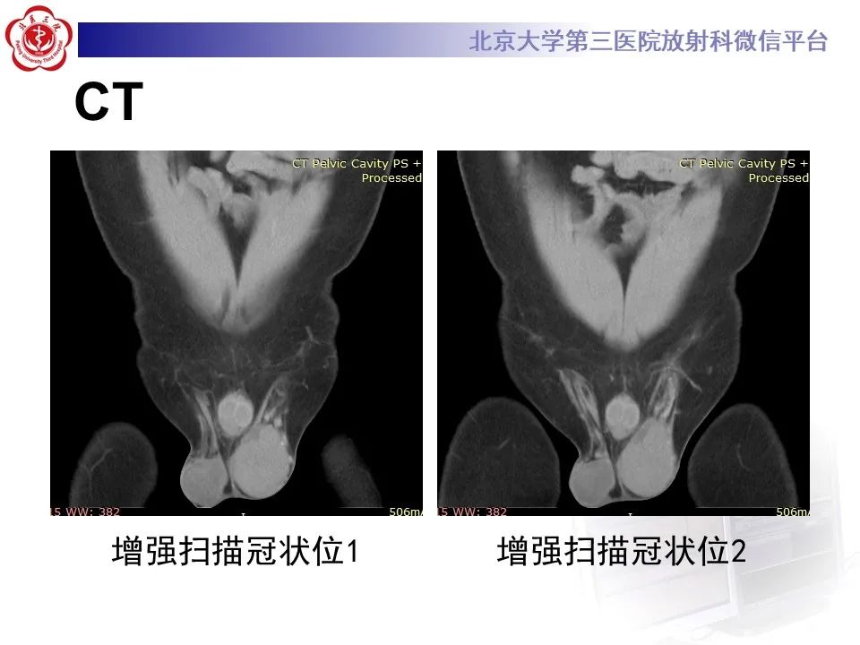 影像PPT - 【PPT】精原细胞瘤的影像-7