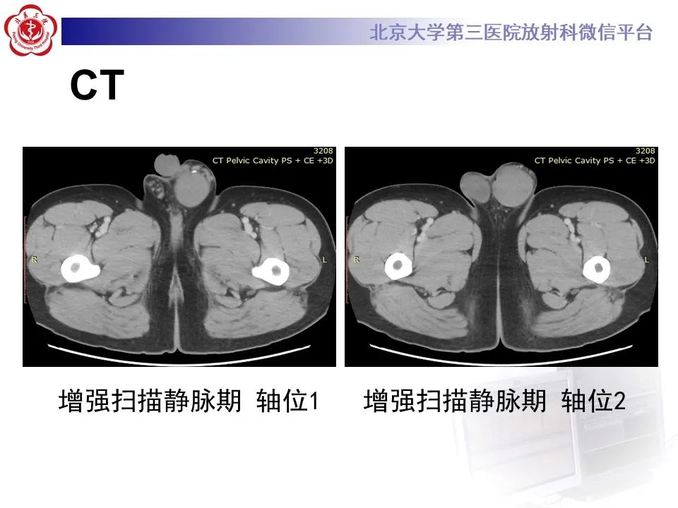 影像PPT - 【PPT】精原细胞瘤的影像-6