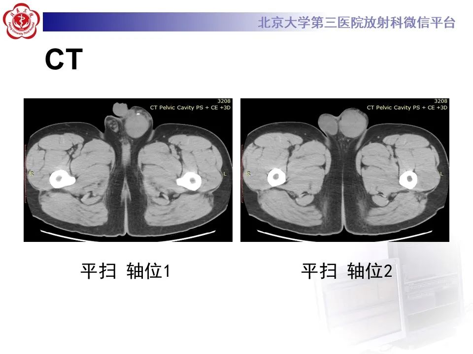影像PPT - 【PPT】精原细胞瘤的影像-4