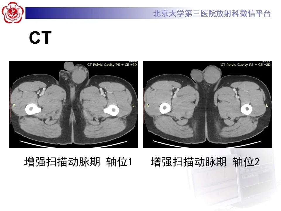 影像PPT - 【PPT】精原细胞瘤的影像-5
