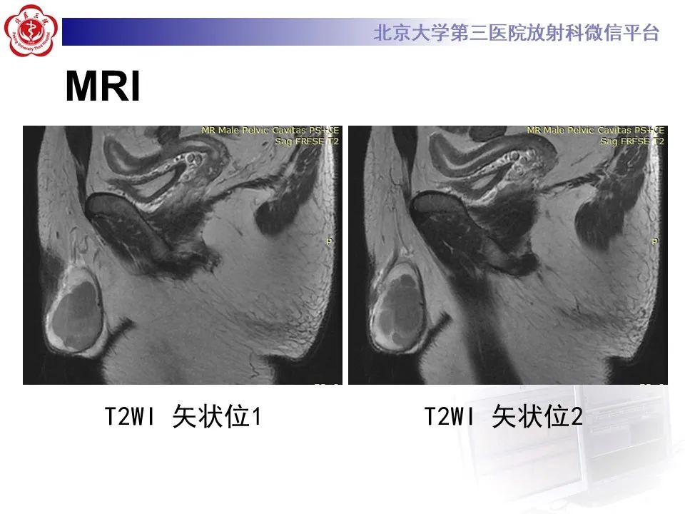 影像PPT - 【PPT】精原细胞瘤的影像-10