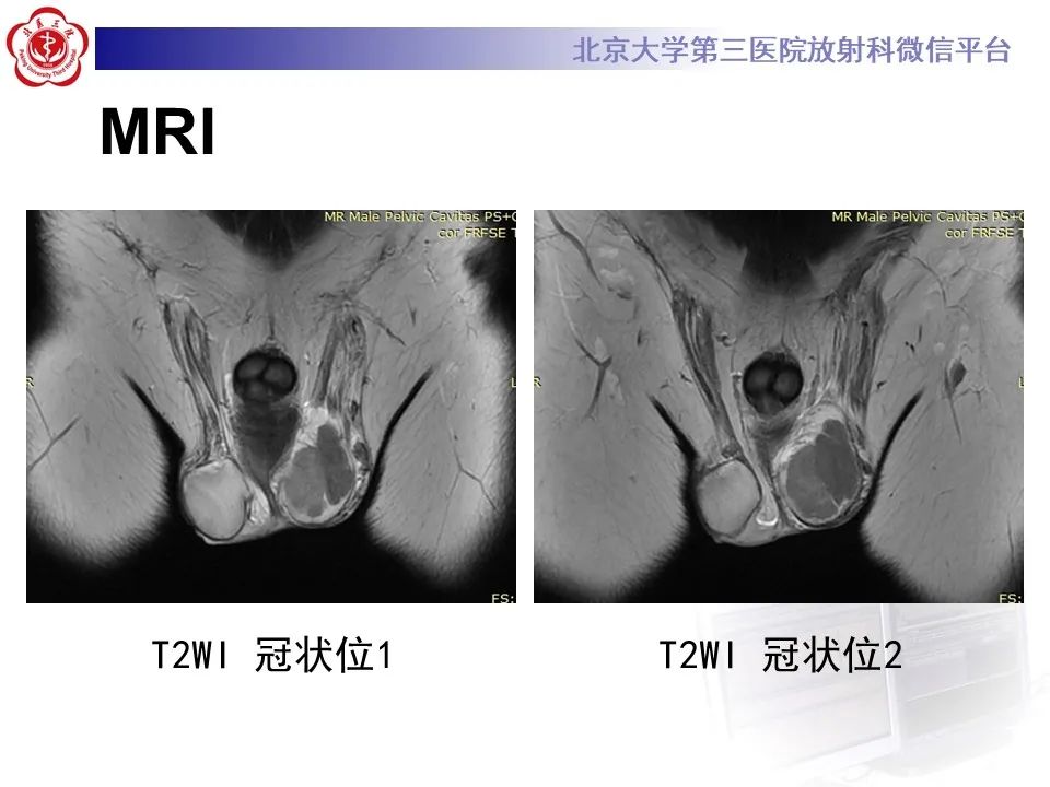 影像PPT - 【PPT】精原细胞瘤的影像-9