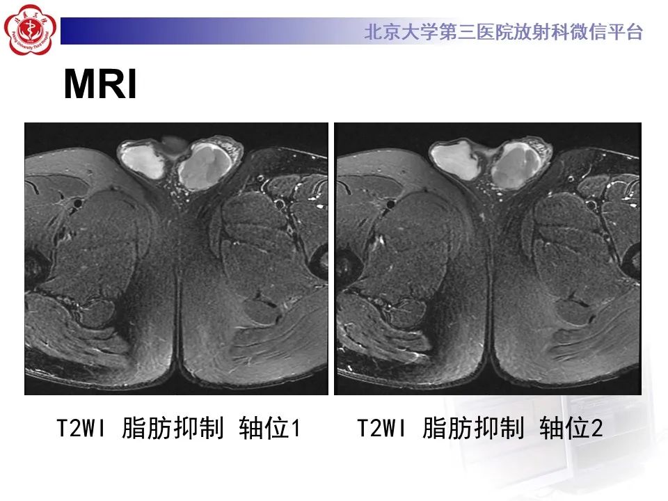 影像PPT - 【PPT】精原细胞瘤的影像-12