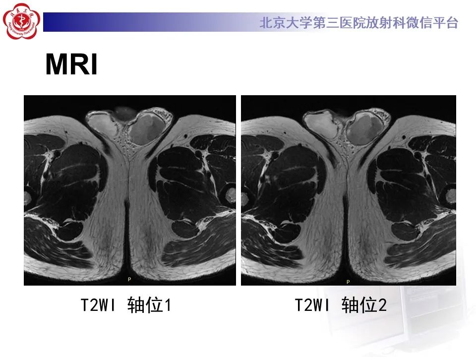 影像PPT - 【PPT】精原细胞瘤的影像-11