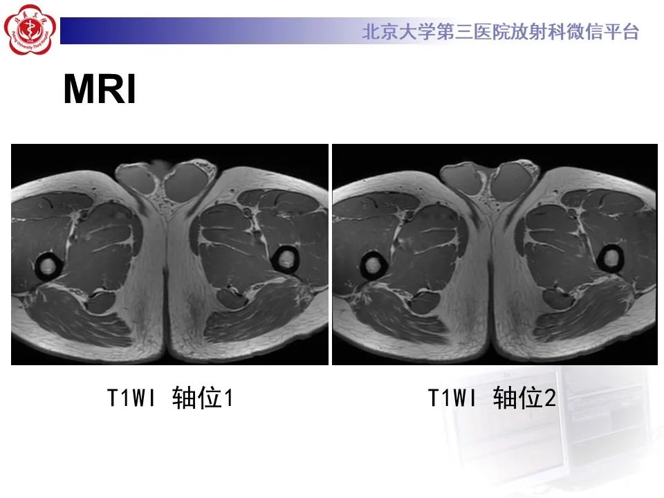 影像PPT - 【PPT】精原细胞瘤的影像-13
