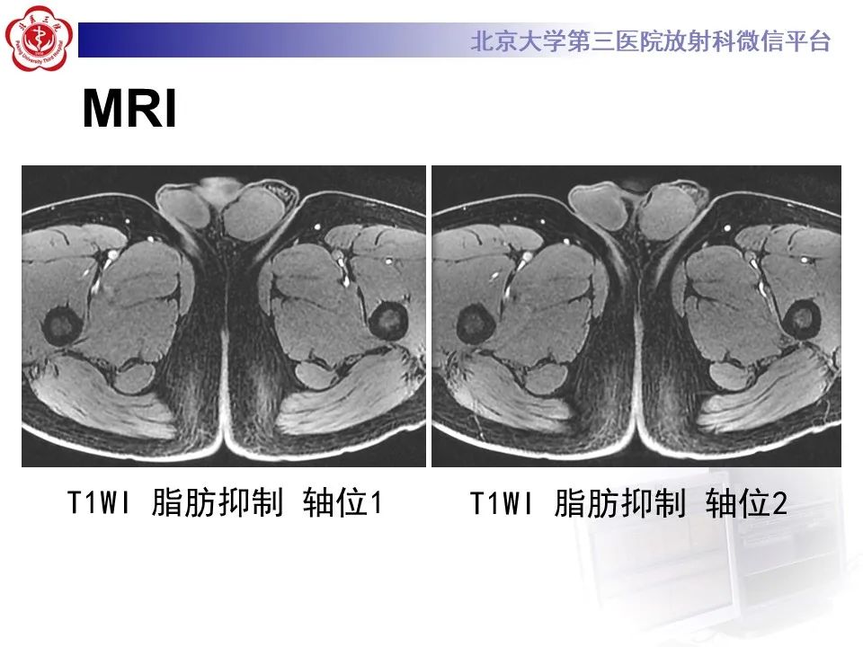 影像PPT - 【PPT】精原细胞瘤的影像-14