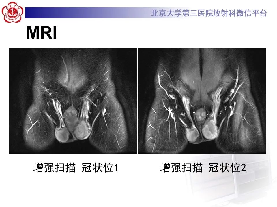 影像PPT - 【PPT】精原细胞瘤的影像-19