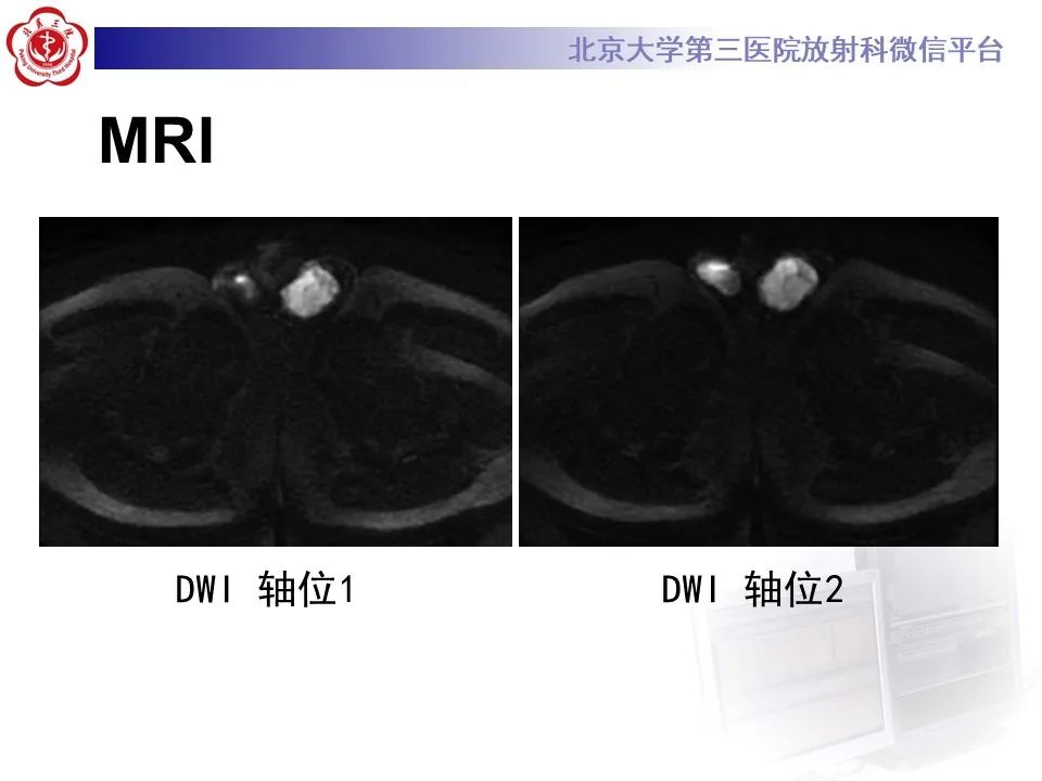 影像PPT - 【PPT】精原细胞瘤的影像-15