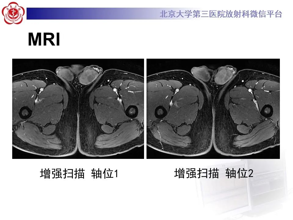 影像PPT - 【PPT】精原细胞瘤的影像-17