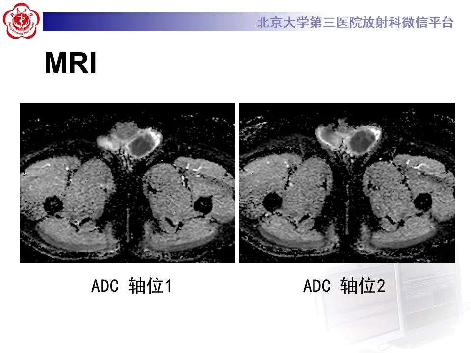 影像PPT - 【PPT】精原细胞瘤的影像-16
