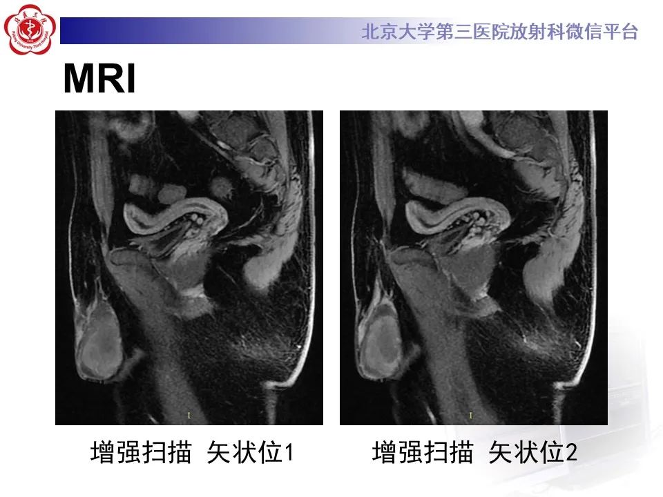 影像PPT - 【PPT】精原细胞瘤的影像-18