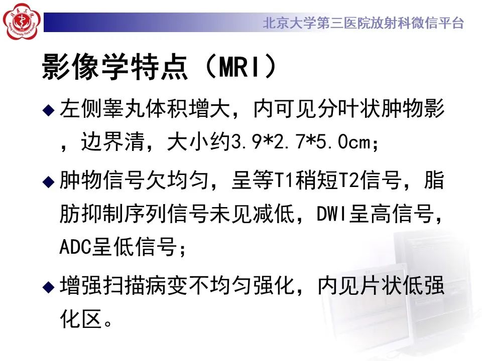 影像PPT - 【PPT】精原细胞瘤的影像-21