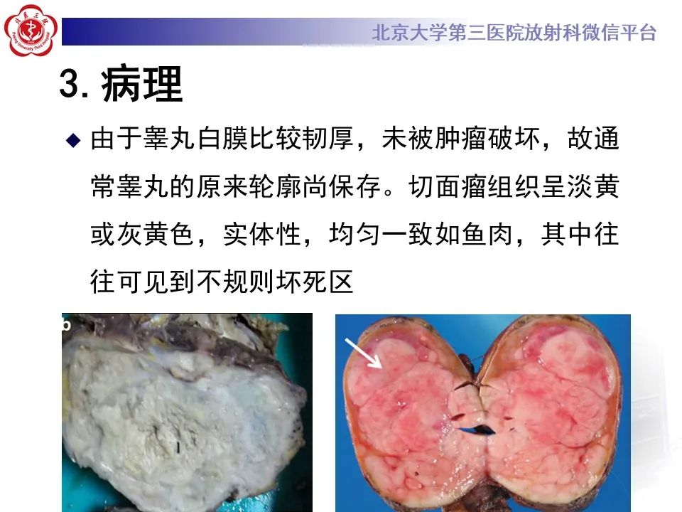 影像PPT - 【PPT】精原细胞瘤的影像-30
