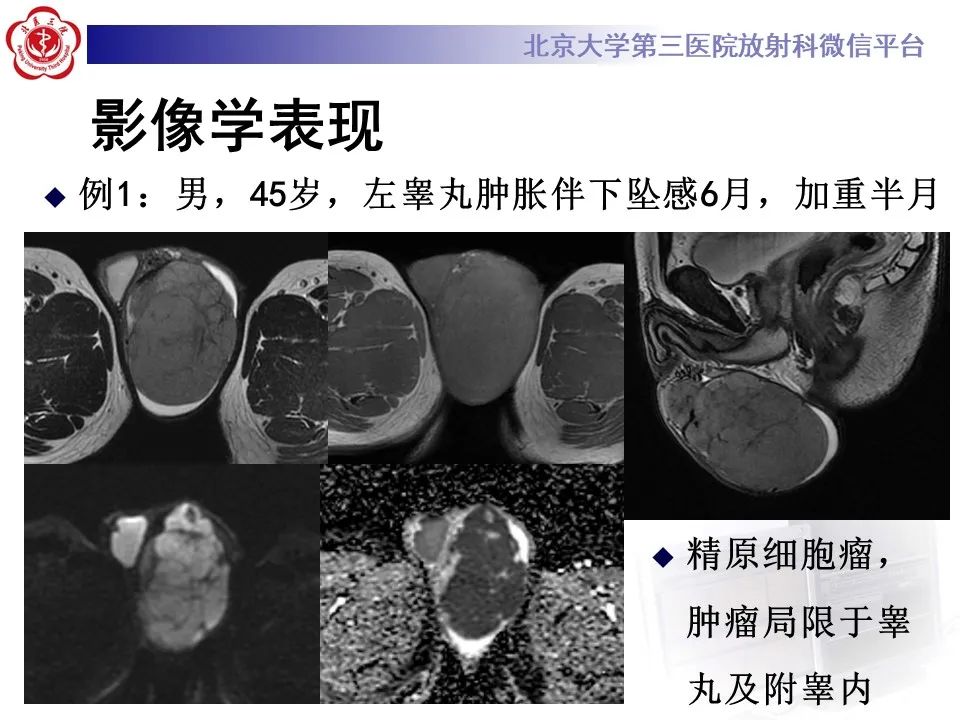 影像PPT - 【PPT】精原细胞瘤的影像-39