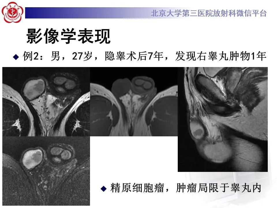 影像PPT - 【PPT】精原细胞瘤的影像-40