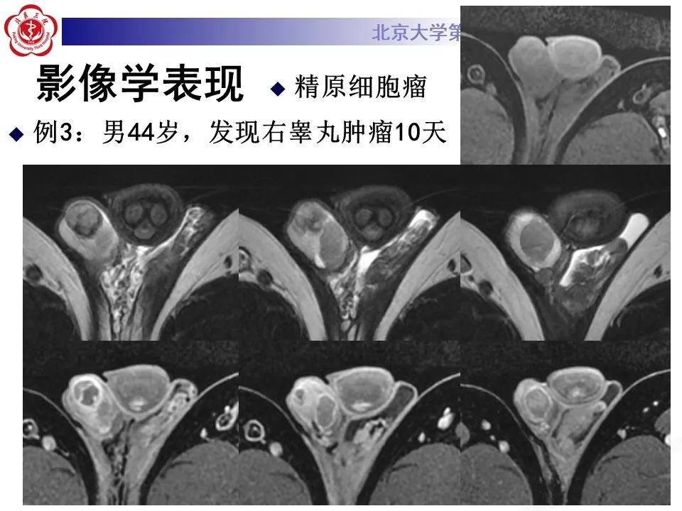 影像PPT - 【PPT】精原细胞瘤的影像-41