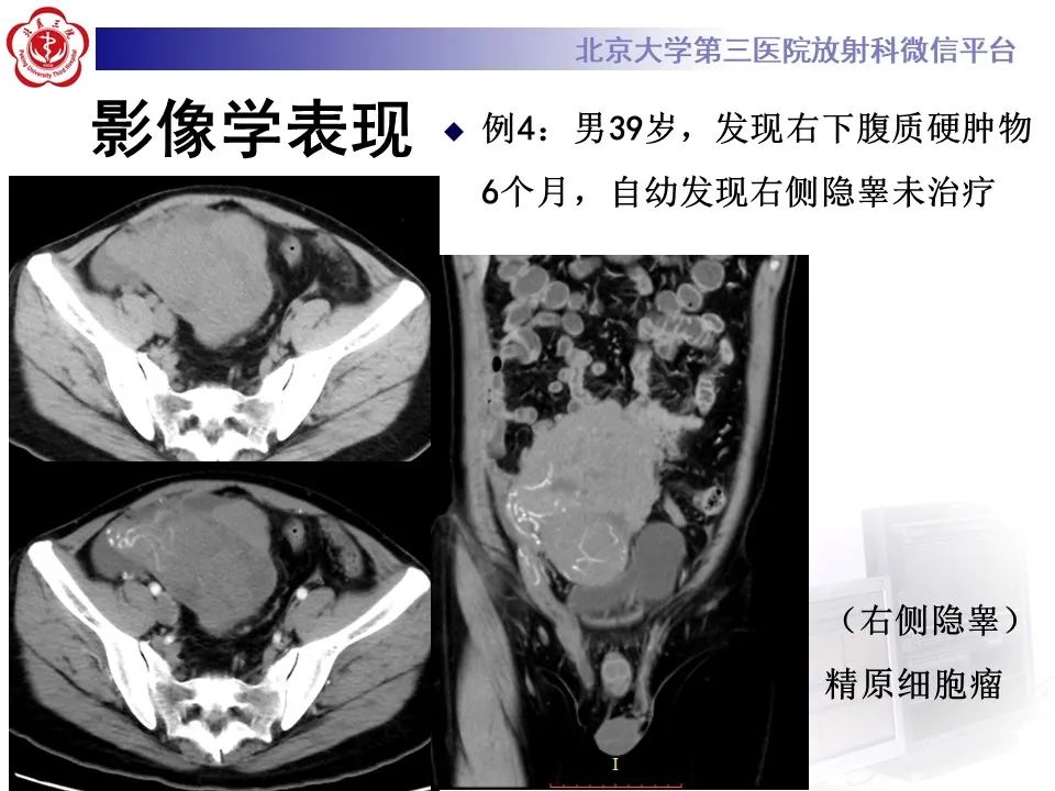 影像PPT - 【PPT】精原细胞瘤的影像-42