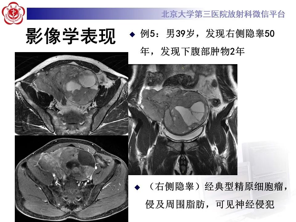 影像PPT - 【PPT】精原细胞瘤的影像-43