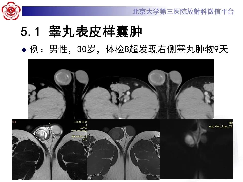 影像PPT - 【PPT】精原细胞瘤的影像-46