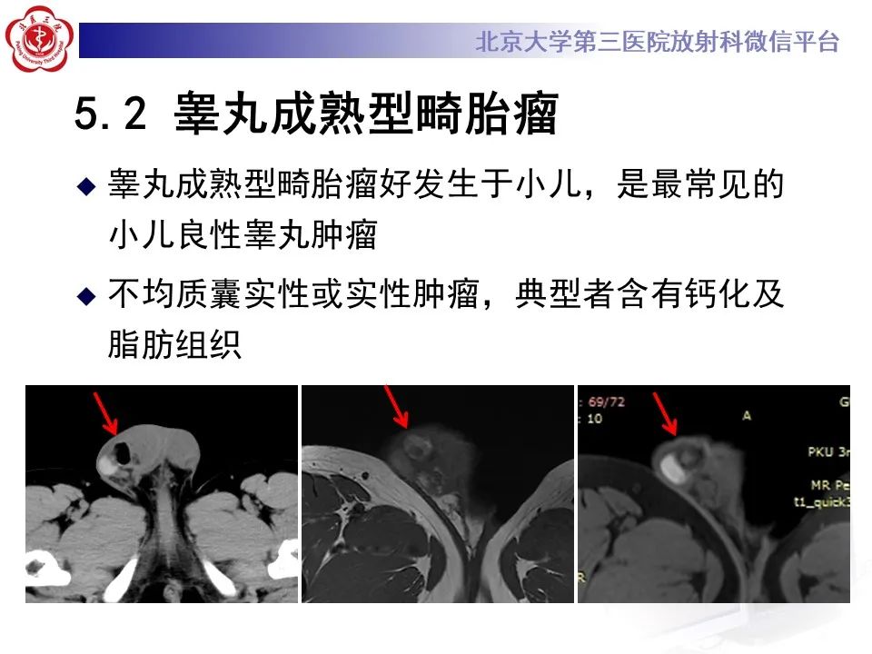 影像PPT - 【PPT】精原细胞瘤的影像-47