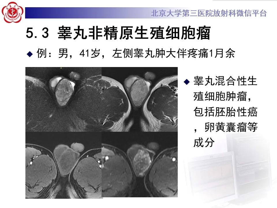影像PPT - 【PPT】精原细胞瘤的影像-49