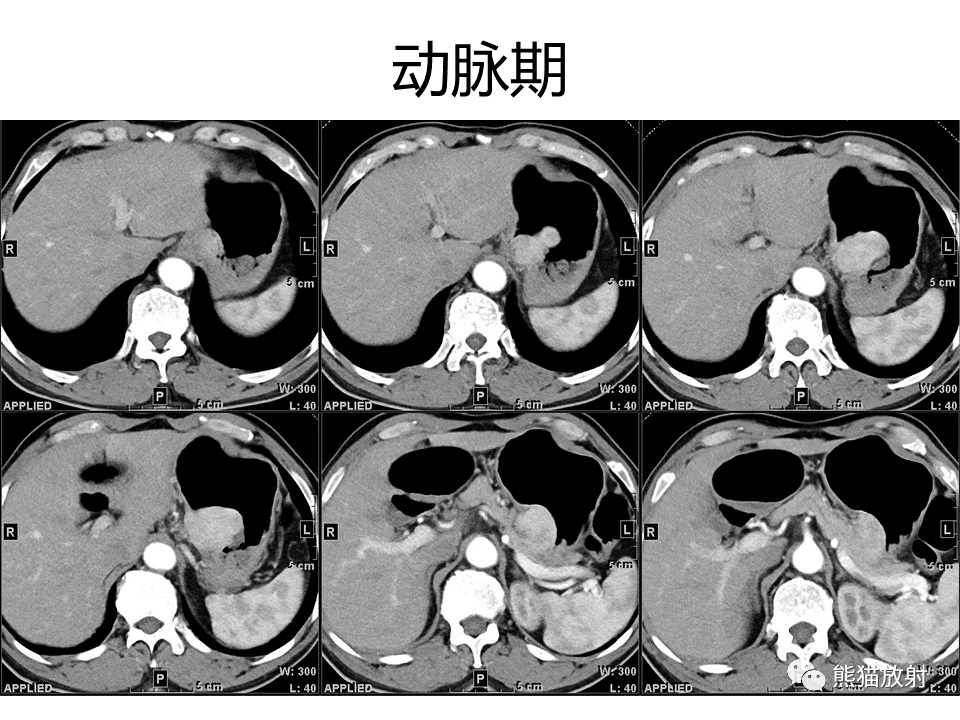 影像PPT - 【病例】胃炎性肌纤维母细胞瘤 VS 胃肠道间质瘤-4