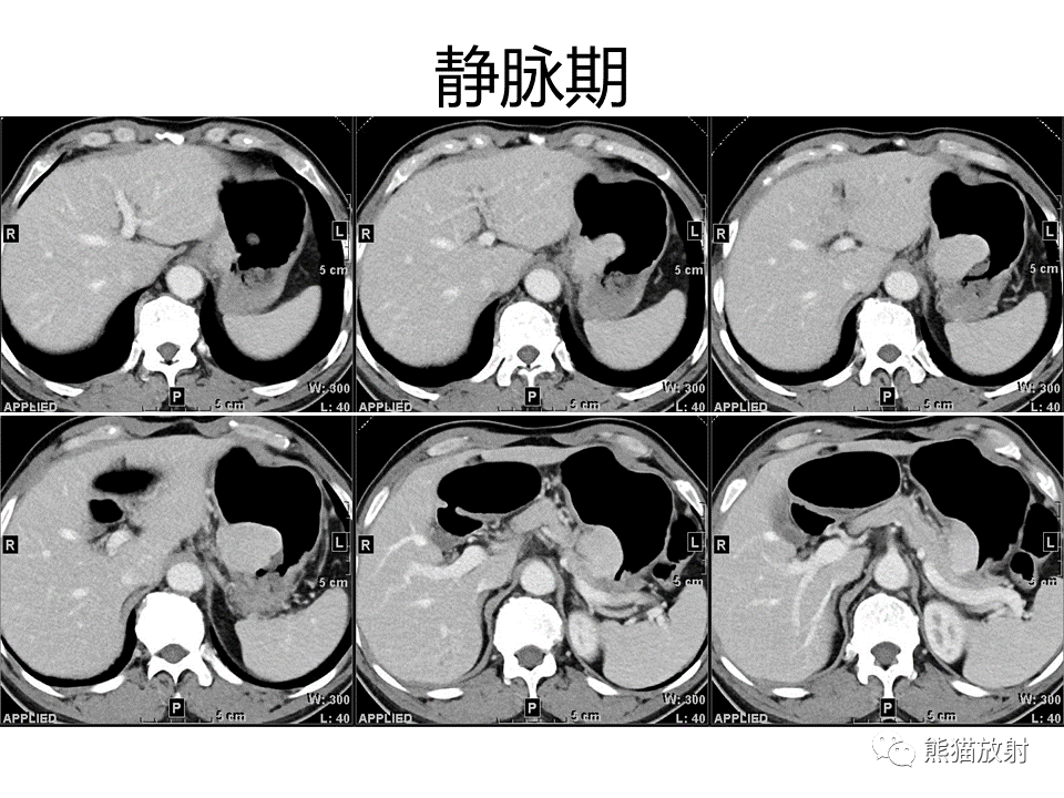 影像PPT - 【病例】胃炎性肌纤维母细胞瘤 VS 胃肠道间质瘤-5