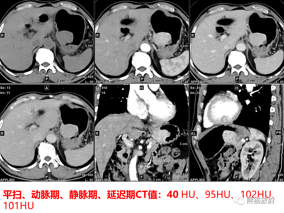 影像PPT - 【病例】胃炎性肌纤维母细胞瘤 VS 胃肠道间质瘤-9