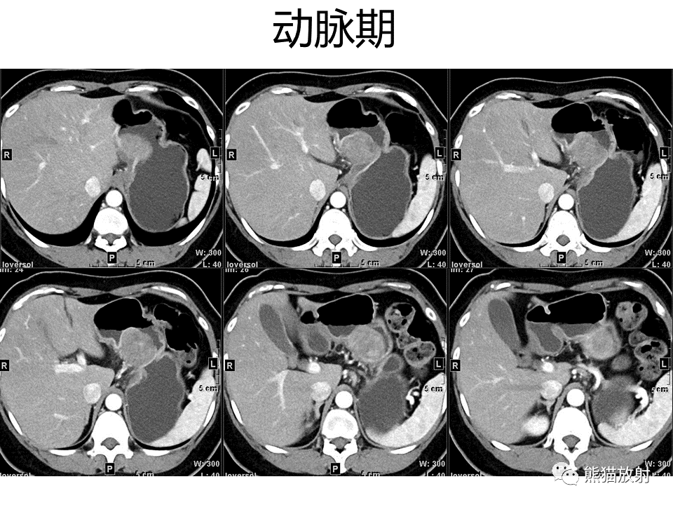 影像PPT - 【病例】胃炎性肌纤维母细胞瘤 VS 胃肠道间质瘤-13