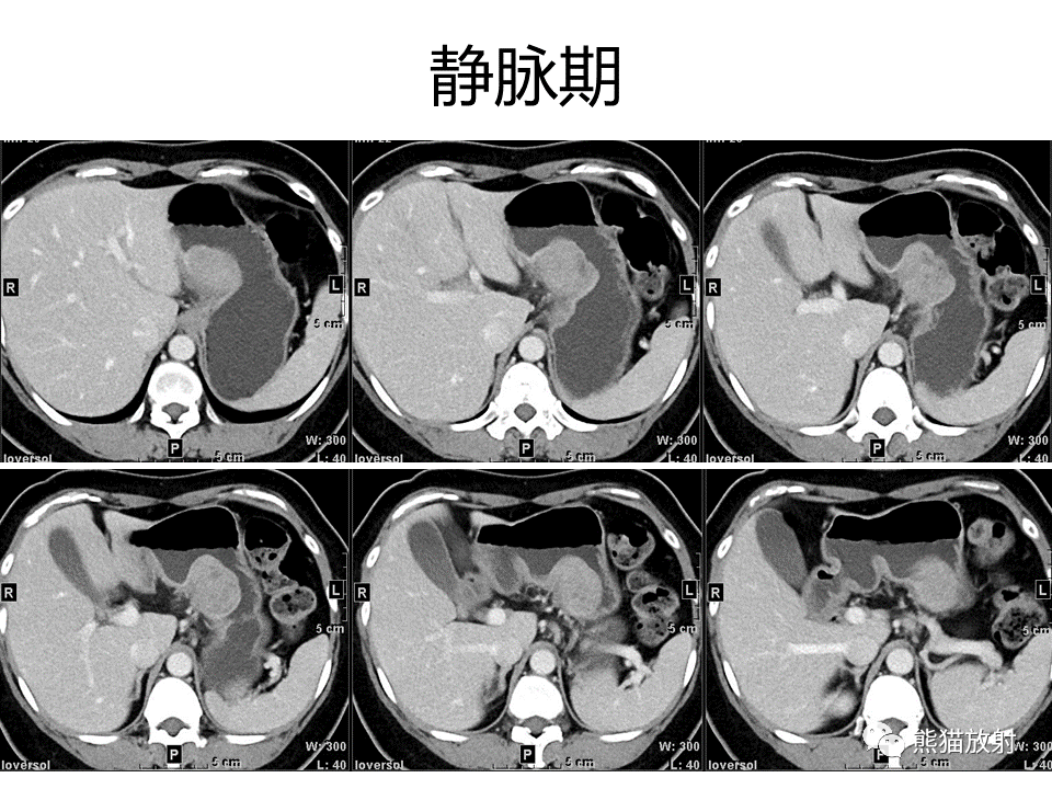 影像PPT - 【病例】胃炎性肌纤维母细胞瘤 VS 胃肠道间质瘤-14