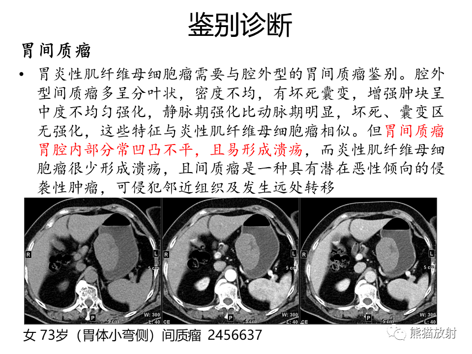 影像PPT - 【病例】胃炎性肌纤维母细胞瘤 VS 胃肠道间质瘤-32