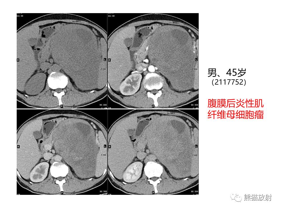 影像PPT - 【病例】胃炎性肌纤维母细胞瘤 VS 胃肠道间质瘤-30