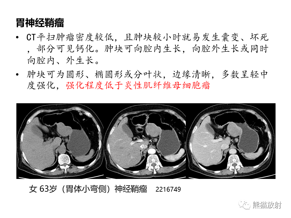 影像PPT - 【病例】胃炎性肌纤维母细胞瘤 VS 胃肠道间质瘤-34