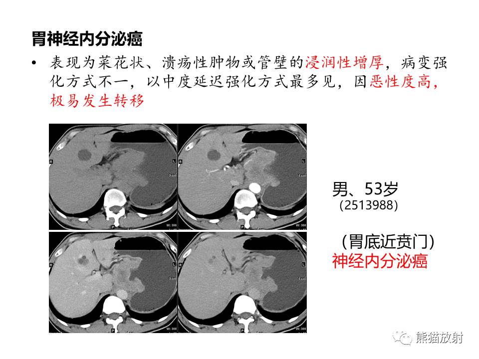 影像PPT - 【病例】胃炎性肌纤维母细胞瘤 VS 胃肠道间质瘤-35