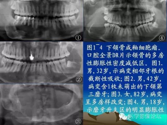 影像PPT - 【PPT】颌骨成釉细胞瘤的影像学诊断-8