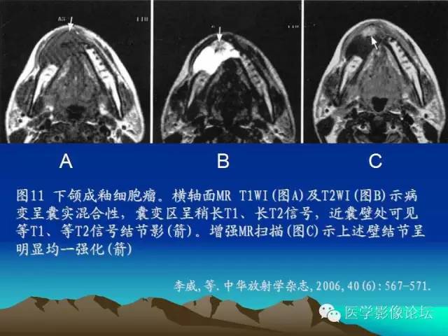 影像PPT - 【PPT】颌骨成釉细胞瘤的影像学诊断-10