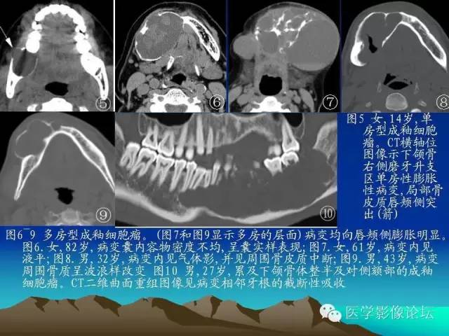 影像PPT - 【PPT】颌骨成釉细胞瘤的影像学诊断-9