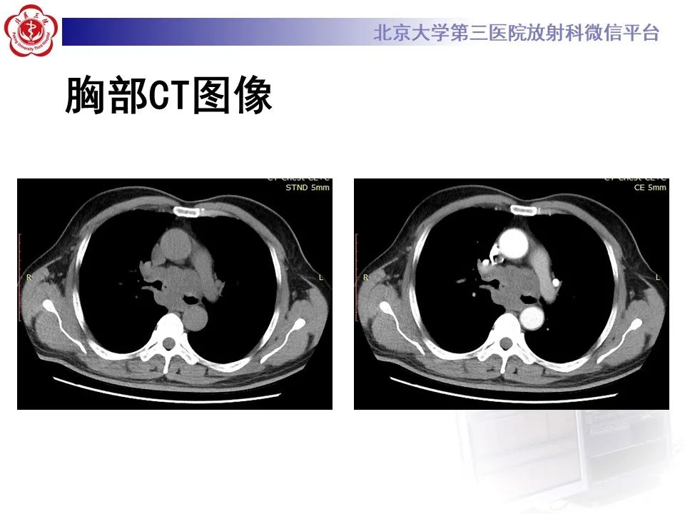 影像PPT - 【PPT】 肺腺样囊性癌的影像-3