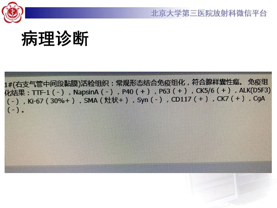 影像PPT - 【PPT】 肺腺样囊性癌的影像-6