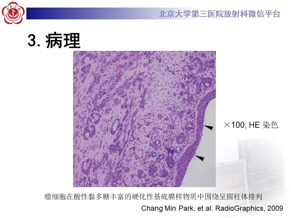 影像PPT - 【PPT】 肺腺样囊性癌的影像-13