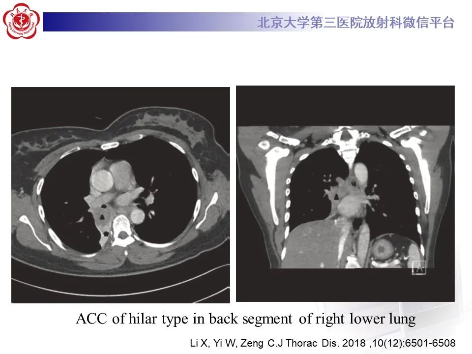 影像PPT - 【PPT】 肺腺样囊性癌的影像-18