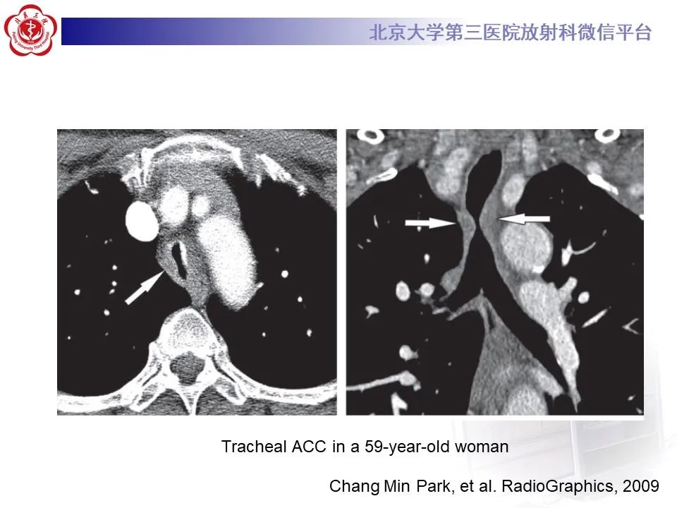 影像PPT - 【PPT】 肺腺样囊性癌的影像-17
