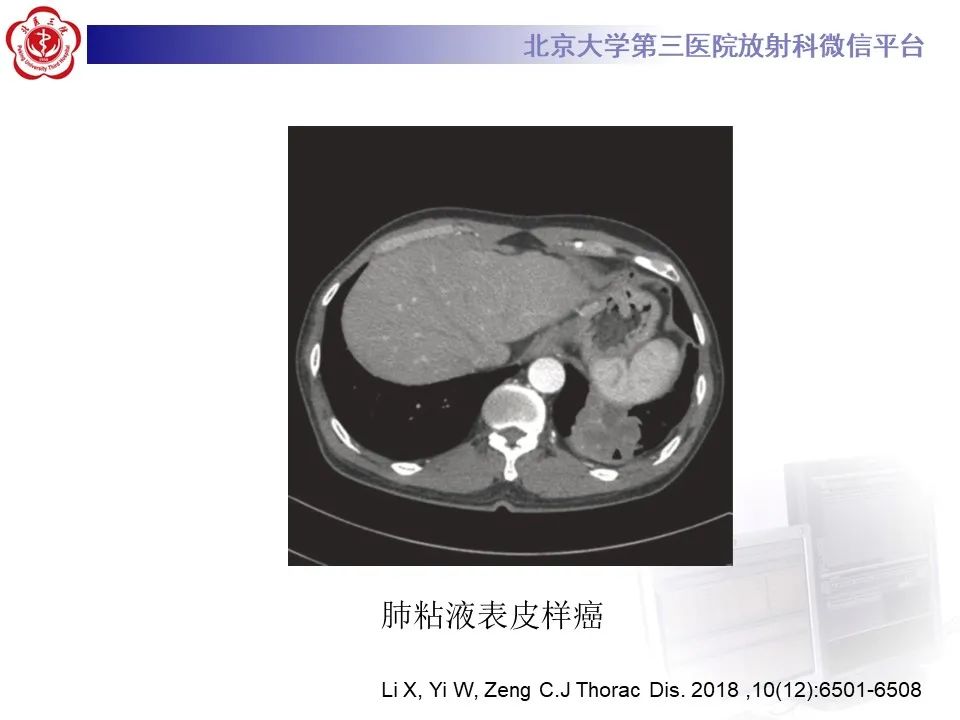 影像PPT - 【PPT】 肺腺样囊性癌的影像-22