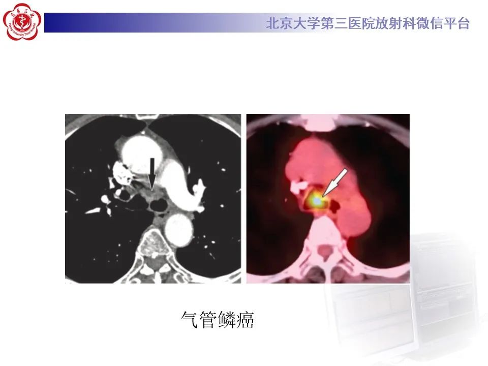 影像PPT - 【PPT】 肺腺样囊性癌的影像-29